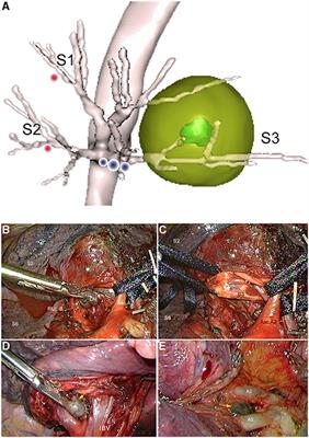 Strategies of Lymph Node Dissection During Sublobar Resection for Early-Stage Lung Cancer